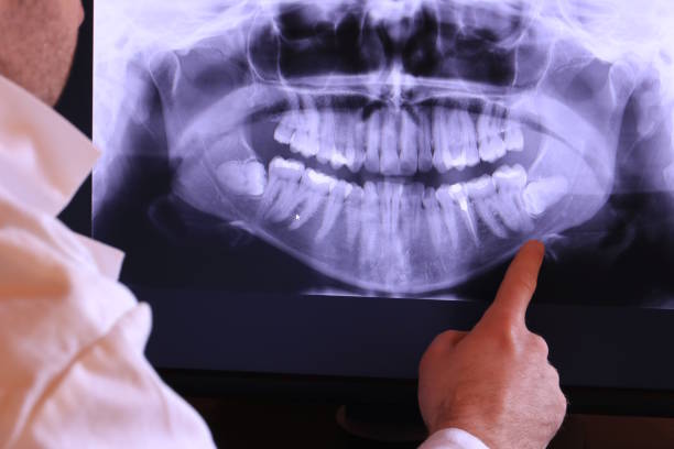Best Emergency Wisdom Teeth Removal in Minden, LA